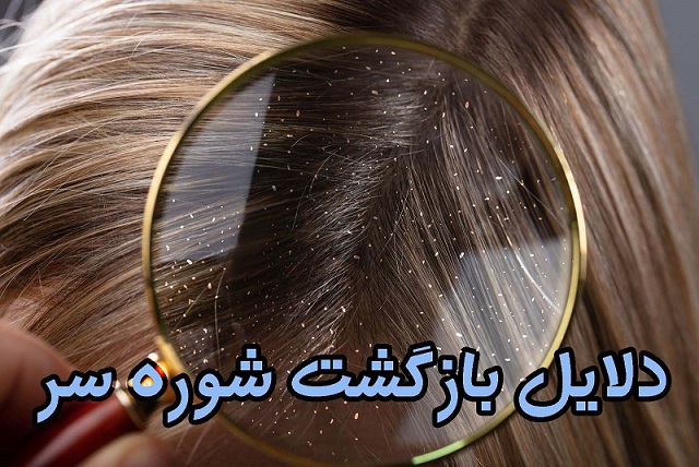 دلایل بازگشت شوره سر دلایل بازگشت شوره سر